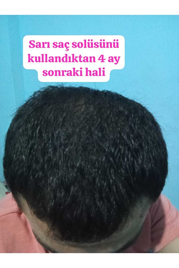 Sarı Saç Solusyonu - 8