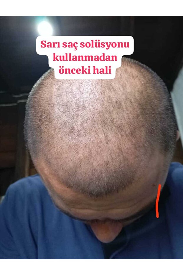 Sarı Saç Solusyonu - 7