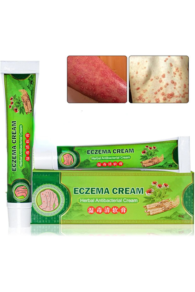 Chinese Herbal Psoriasis Creams