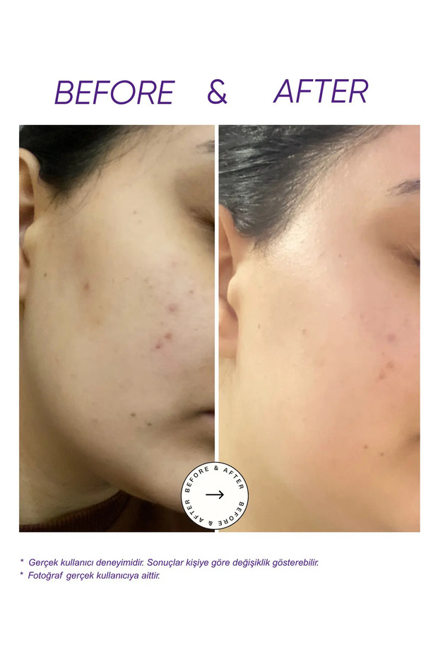 Leke Karşıtı Serum 30 ml | Traneksamik Asit, Alpha Arbutin, Niacinamide ve C Vitamini ile Ton Eşitsizliği ve Koyu Leke Görünümü Bakımı - 3