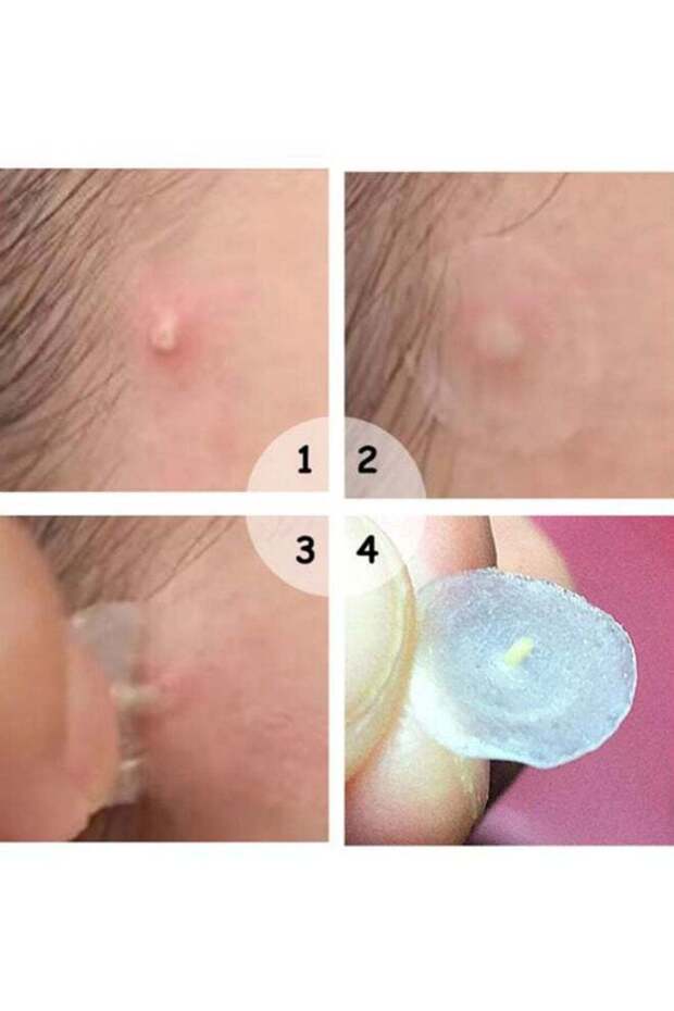 رقعة حب الشباب غير المرئية - 4