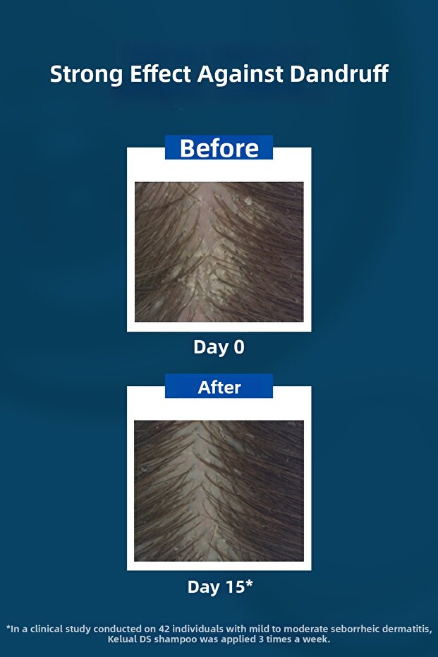 Kelual Ds Shampoo 100 ml - 3