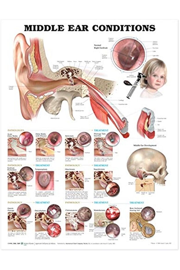 Middle Ear Conditions Anatomical Chart