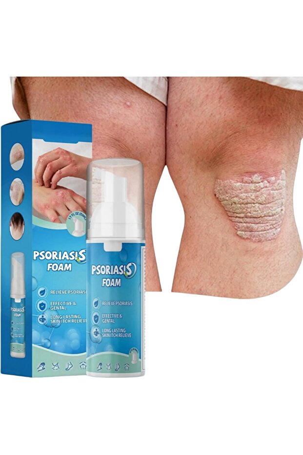 Psoriasis Foam 50Ml Treatment