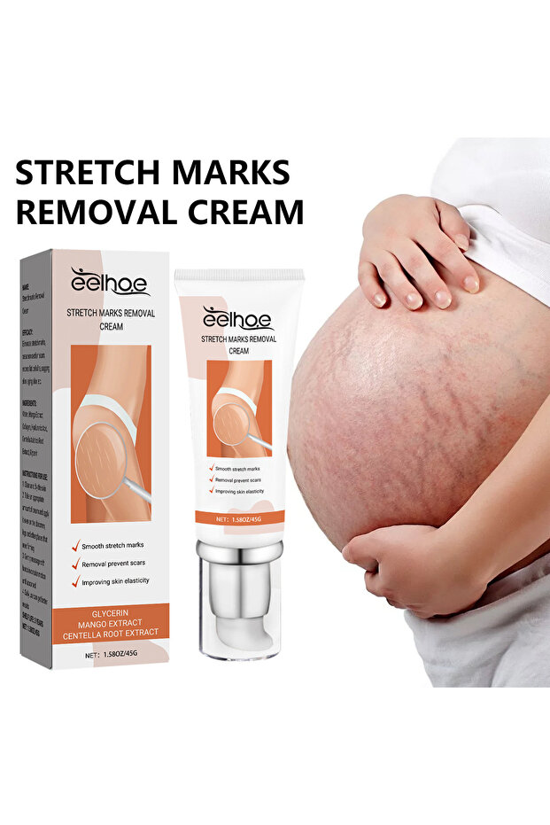 Stretch Mark Removal Cream Treatment Scars Acne Stretch Marks Remove Postpartum Anti Wrinkle
