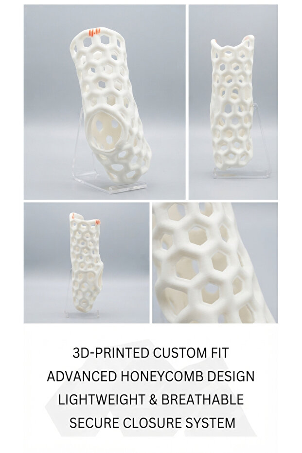 3D-Printed Custom Fit Brace