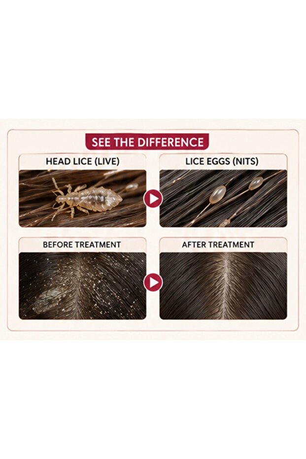 Lice removing - 3