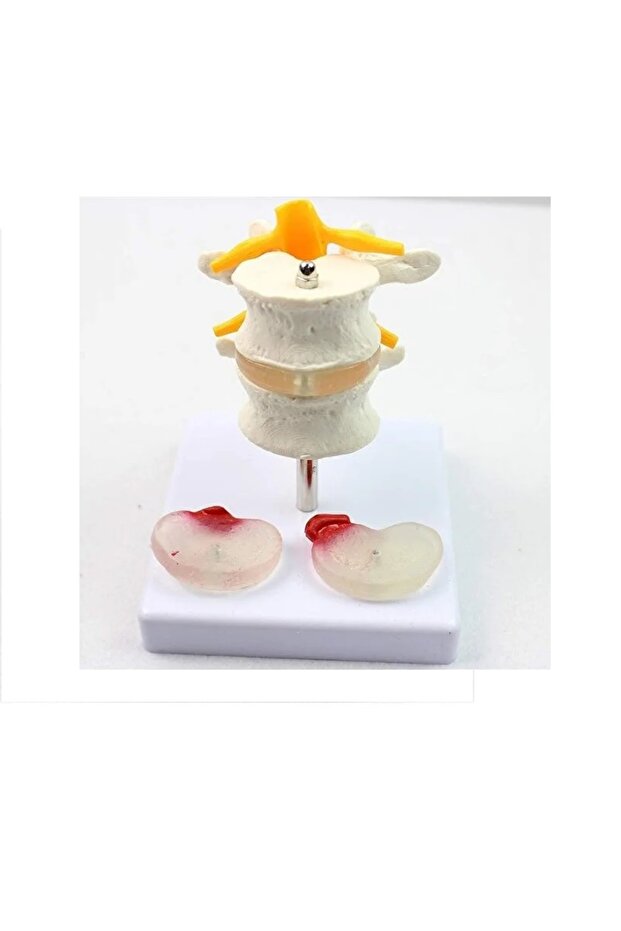 Lumbar Vertebra Disk Hernisi Omurga Modeli Model 4