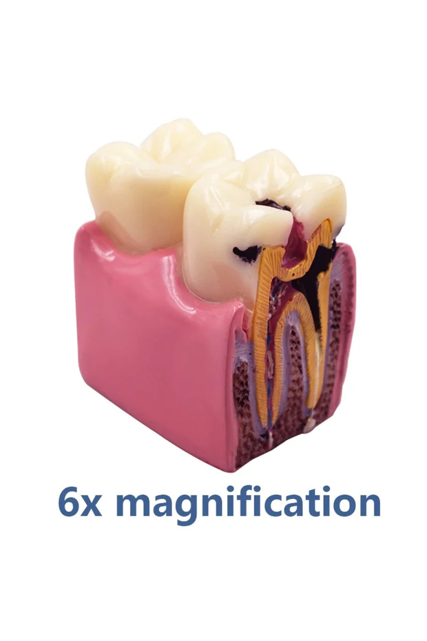 tooth model 6x 8 Times Dental Caries Model Disease Teeth Dental Model for Dental Demonstration Model