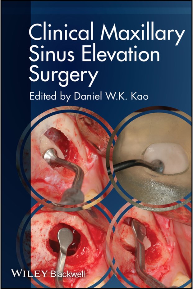 Clinical Maxillary Sinus Elevation Surgery