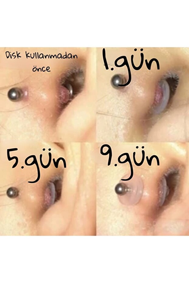 4 Adet Şişlik Giderici Silikon Disk - 2