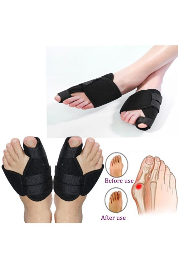 علاج مصحح جبيرة إبهام القدم الليلية من Hallux Valgus، واقي عظام الورم