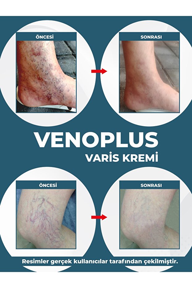 Venoplus Kremi - 4