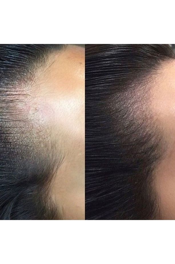 Scalp Pigment - Saç Simülasyon Pigmenti - Saç Simülasyon Boyası - 4