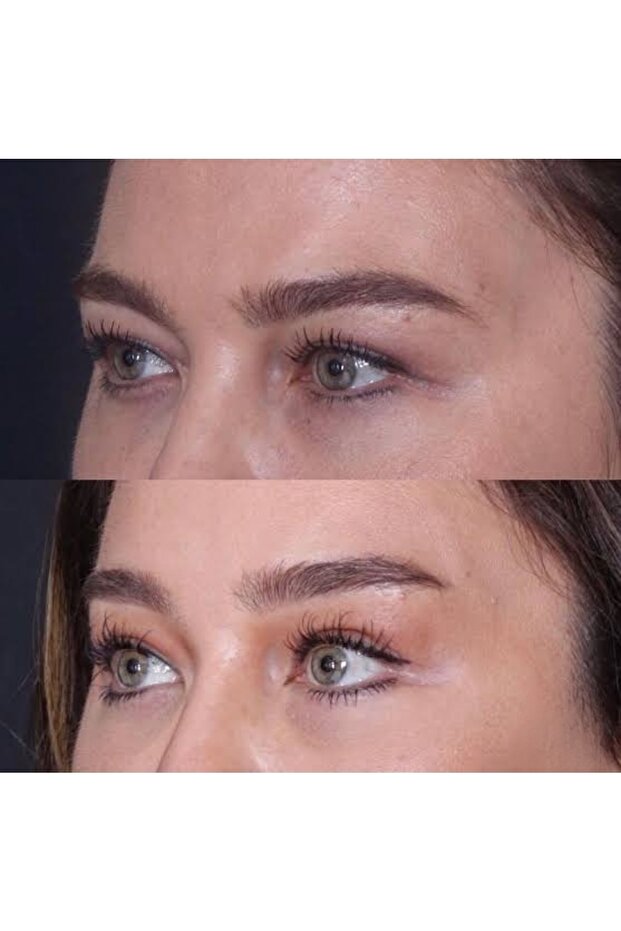 Botox Clip Face Lift (Brown) Eyebrow Lift Cat Eye