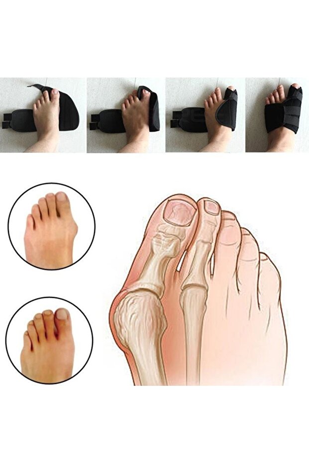 Gece Ayak Başparmak Ateli Medikal Atel Bunion Koruyucu Ayak Başparmak Kemik Çıktısı Tedavisi - 2