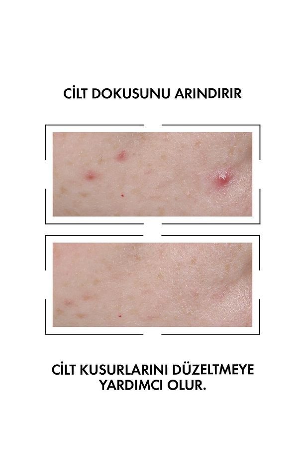 Normaderm Leke Karşıtı Serum 30 ml + Normaderm Phytosolution Arındırıcı Jel 50ml.Set - 7