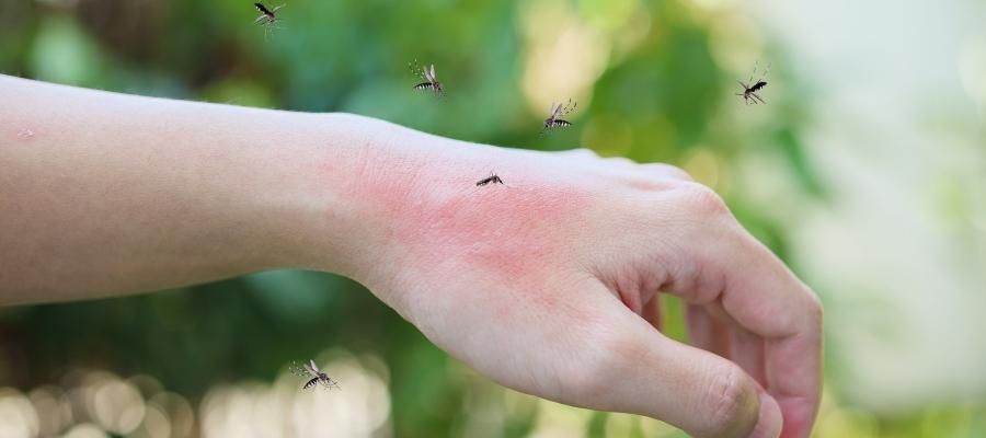 Kaşıntıdan Kurtulun: Sivrisinek Isırığına Ne İyi Gelir?