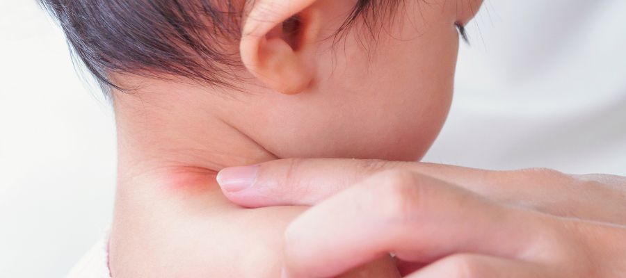 Bebeklerde Boyunda İsilik Nasıl Tedavi Edilir? 