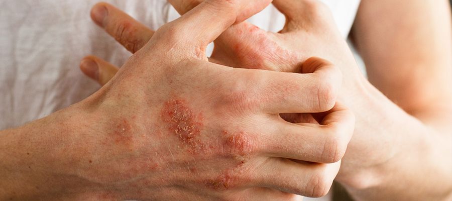 Egzama (Atopik Dermatit) Nedir?