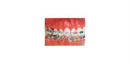 GC Dentalsepet Ortodonti Diş Teli Mumu Özellikleri