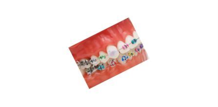 GC Dentalsepet Diş Teli Mumu Avantajları ve Kullanımı