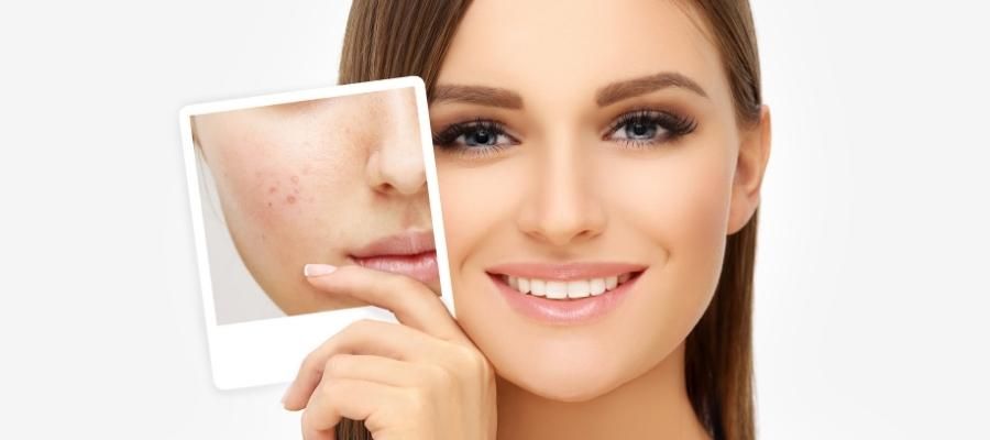 Cilt Sağlığı ve Sorunları: Kör Sivilce Nedir?