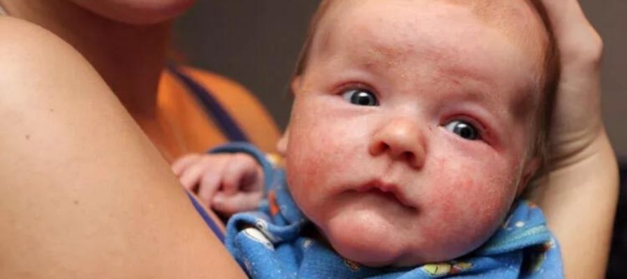 Bebeklerde Yumurta Alerjisi Belirtileri Nelerdir?