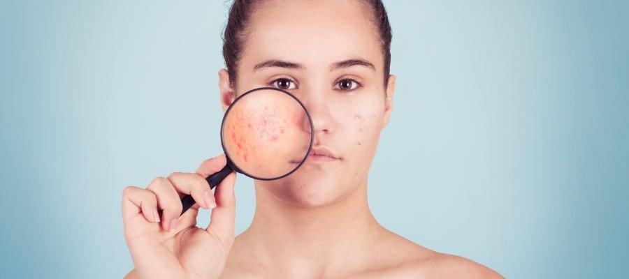 Benzoil Peroksit Kullanırken Dikkat Edilmesi Gerekenler