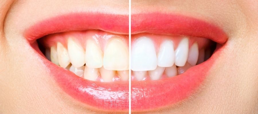 Dişlerdeki Demir Lekeleri İçin Doğal Çözümler
