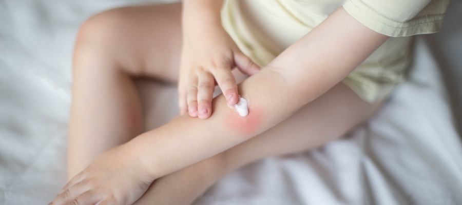 Hassas Koruma: Bebeklerde Yanık Kremi Seçimi