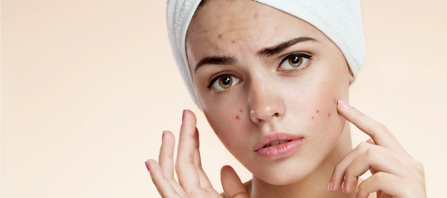 Sivilce İzleri Nasıl Geçer?