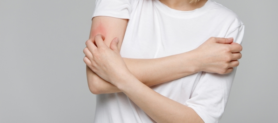 Kurdeşen Tedavisi için Uygulanan Yöntemler