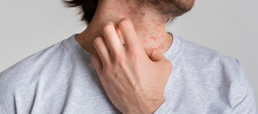 Kaşıntılı Bir Deri Sorunu: Kurdeşen Nedir?