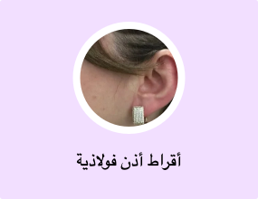 أقراط معدنية