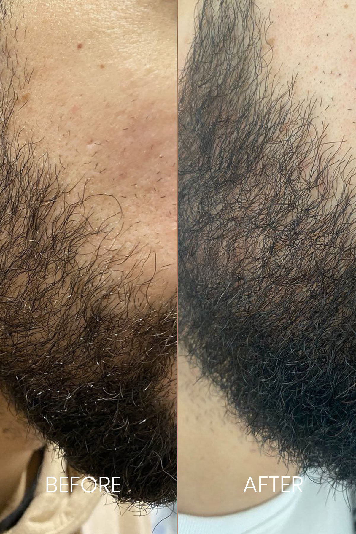 Mavi Sakal Serumu 30 ml – Seyrek/Boş Bölgeler İçin Yoğun Etkili Sakal Bakım Serumu | Sakal Güçlendirici | Mavi Serum | Sakal Dermaroller | Erkek Bakım | Sakal Bakımı — 8681967480733 — تصویر 6 از 6