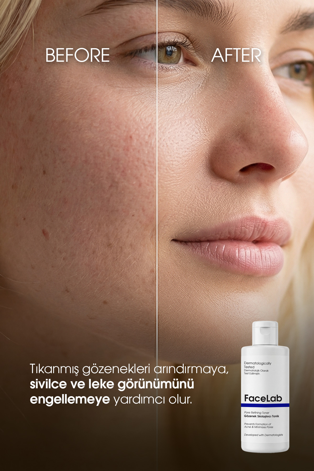 Salisilik Asit (BHA) Tonik 200 ml – Akne & Karşıtı, Gözenek Sıkılaştırıcı Arındırıcı Tonik | Yüz Toniği | Sebum Dengeleyici Tonik | Siyah Nokta Toniği | Cilt Toniği — 8682835473109 — تصویر 2 از 6