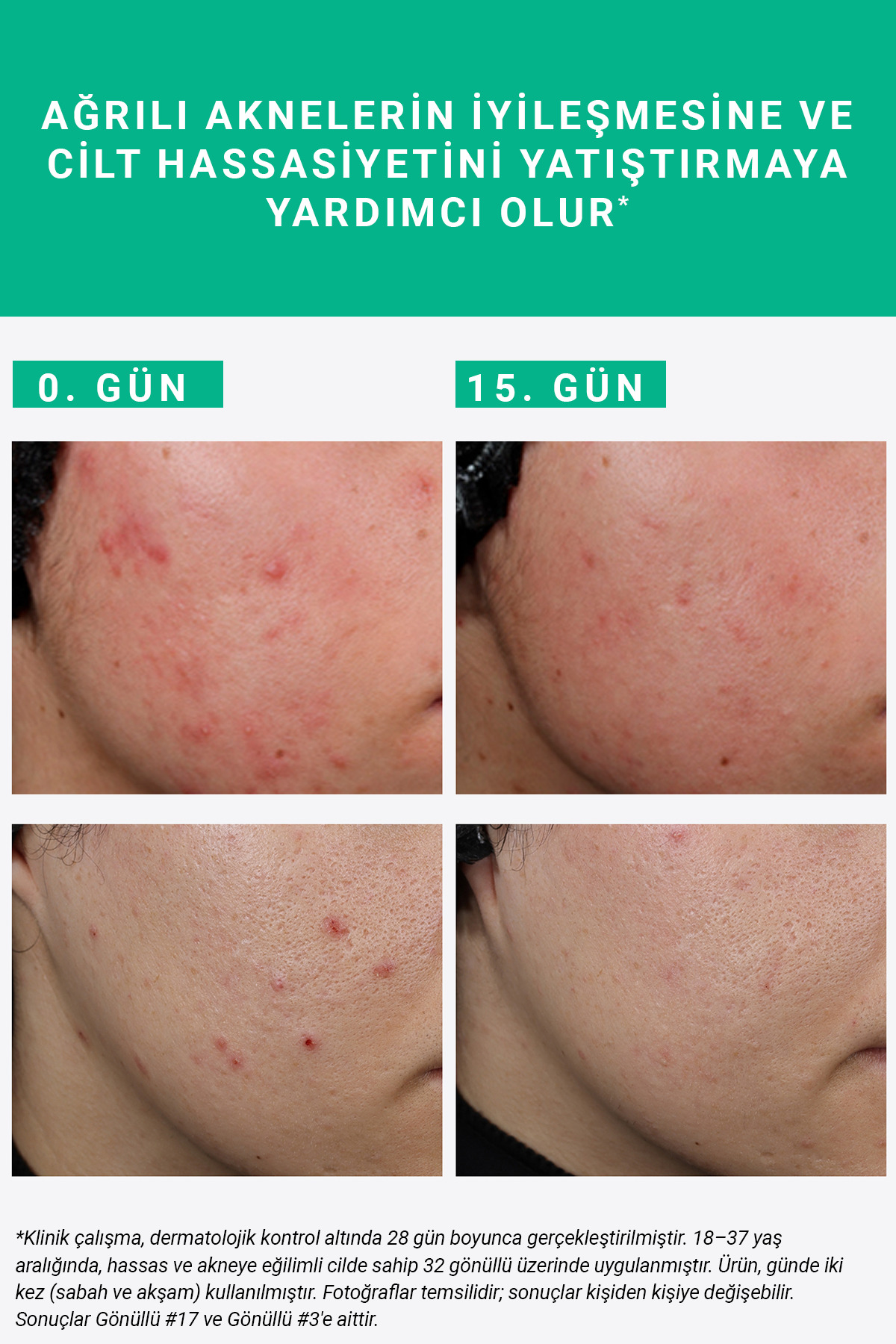 Pure Active Süksinik Asit %2 Hassas Ciltler için Akne ve Leke Karşıtı Konsantre Bakım Serumu 15 ML — 3001315652 — تصویر 9 از 10