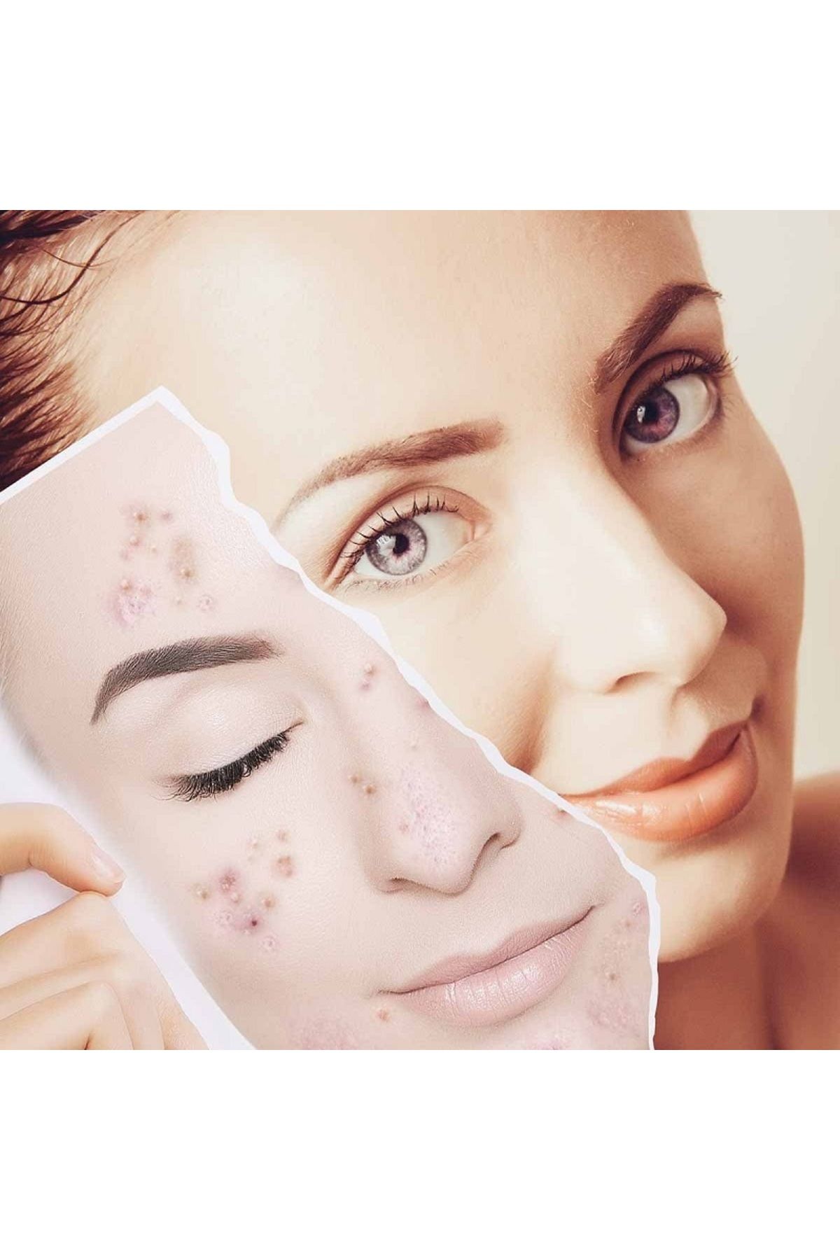 Miss Aura-Skin Care Mask Effective Against Acne and Blackhead Formation-Acnes-Derm, 50ml 5