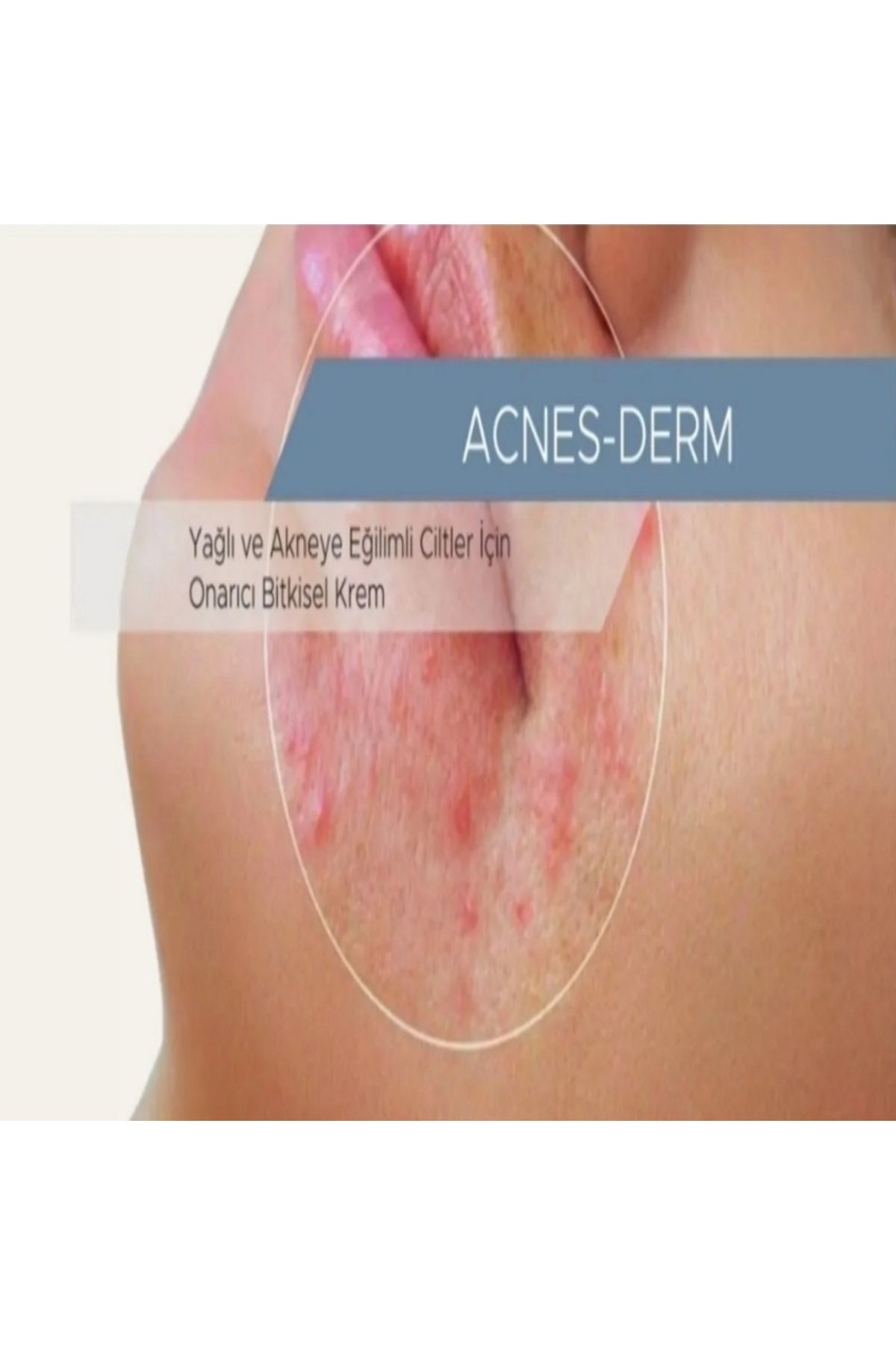 Miss Aura-Skin Care Mask Effective Against Acne and Blackhead Formation-Acnes-Derm, 50ml 3
