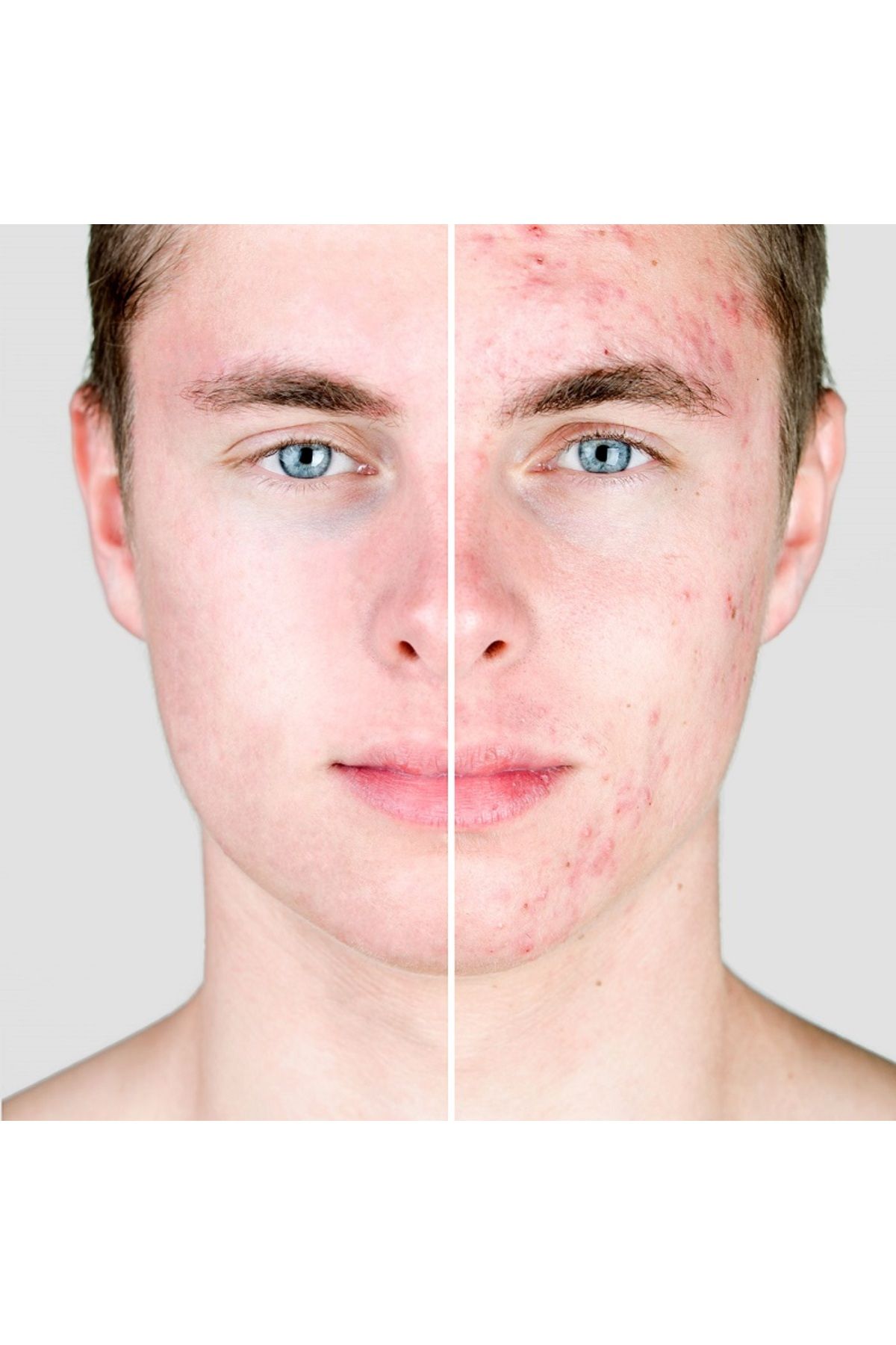 Miss Aura-Skin Care Mask Effective Against Acne and Blackhead Formation-Acnes-Derm, 50ml 7