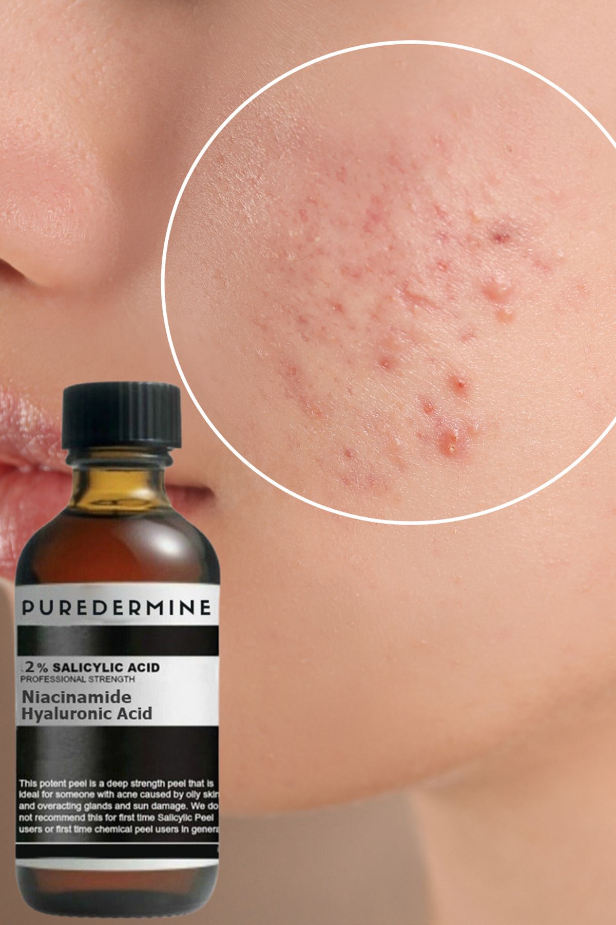 Puredermine-Salicylic Acid & Dull Clogged Pores & Blackhead & Acne Serum & Niacinamide + Ha 5