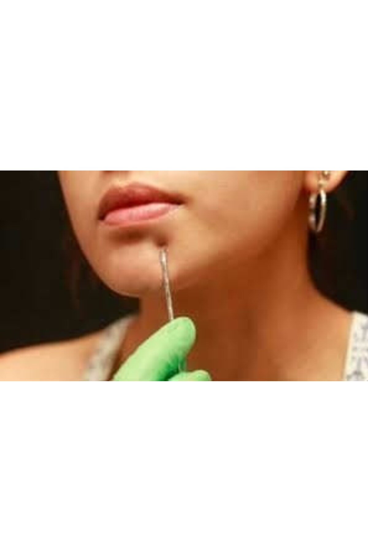 ابزار پاکسازی صورت جوش‌های سرسیاه، ست کومدون، ابزار دو تکه استیل ضد زنگ مخصوص آکنه، پاک کننده آکنه — PRA-9931100-2231 — تصویر 4 از 5