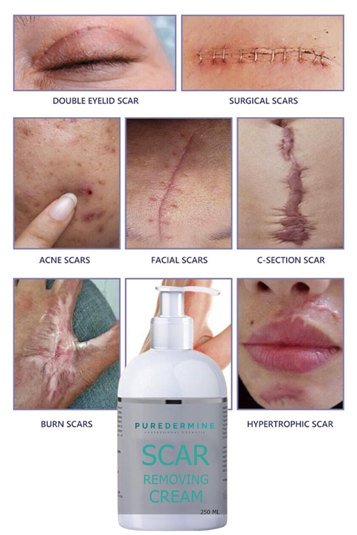Best acne scar removal cream sales