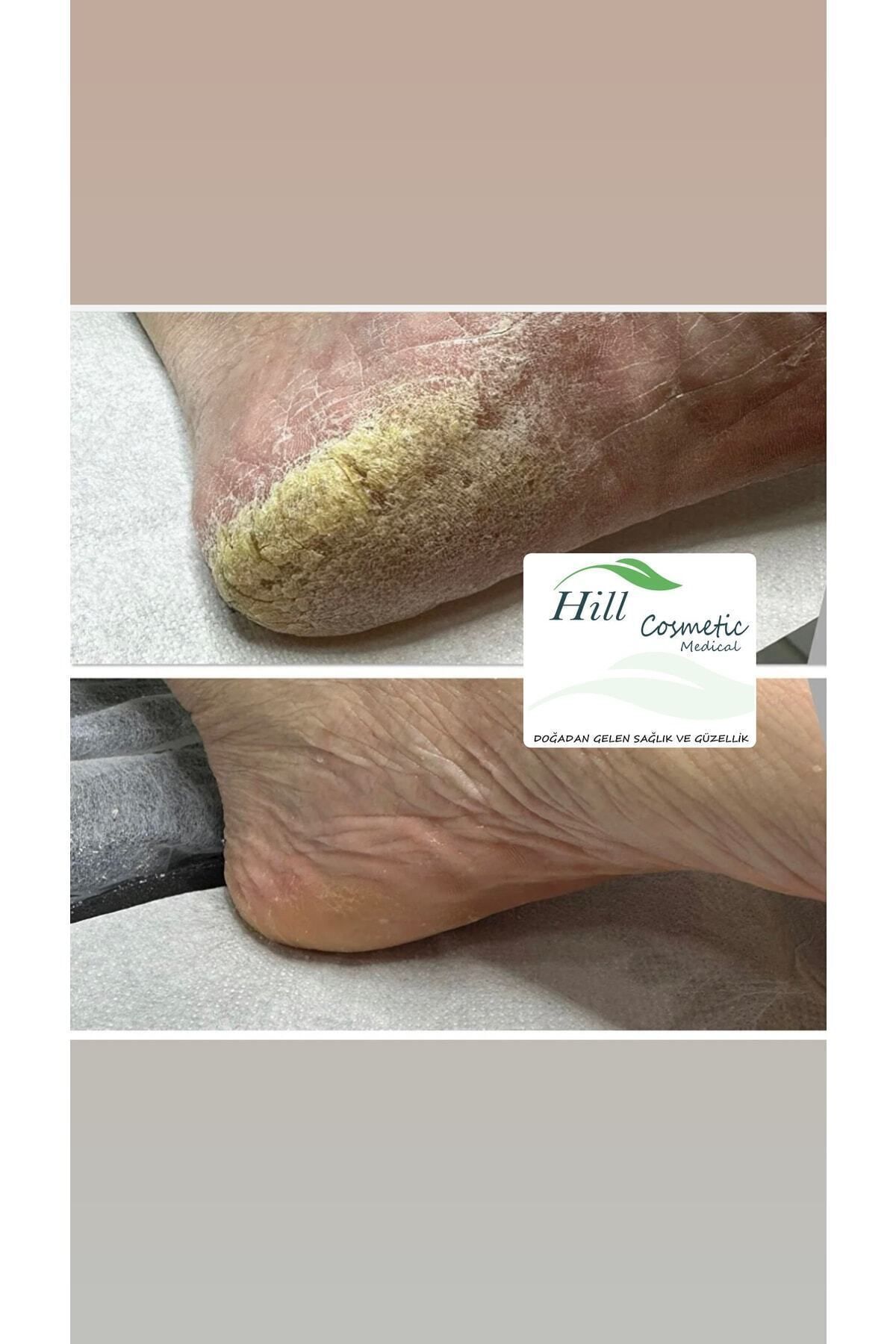 hillfoot-Hill Cosmetic General Foot Care and Heel Cream (Callus and Heel Crack, ) Podology 5