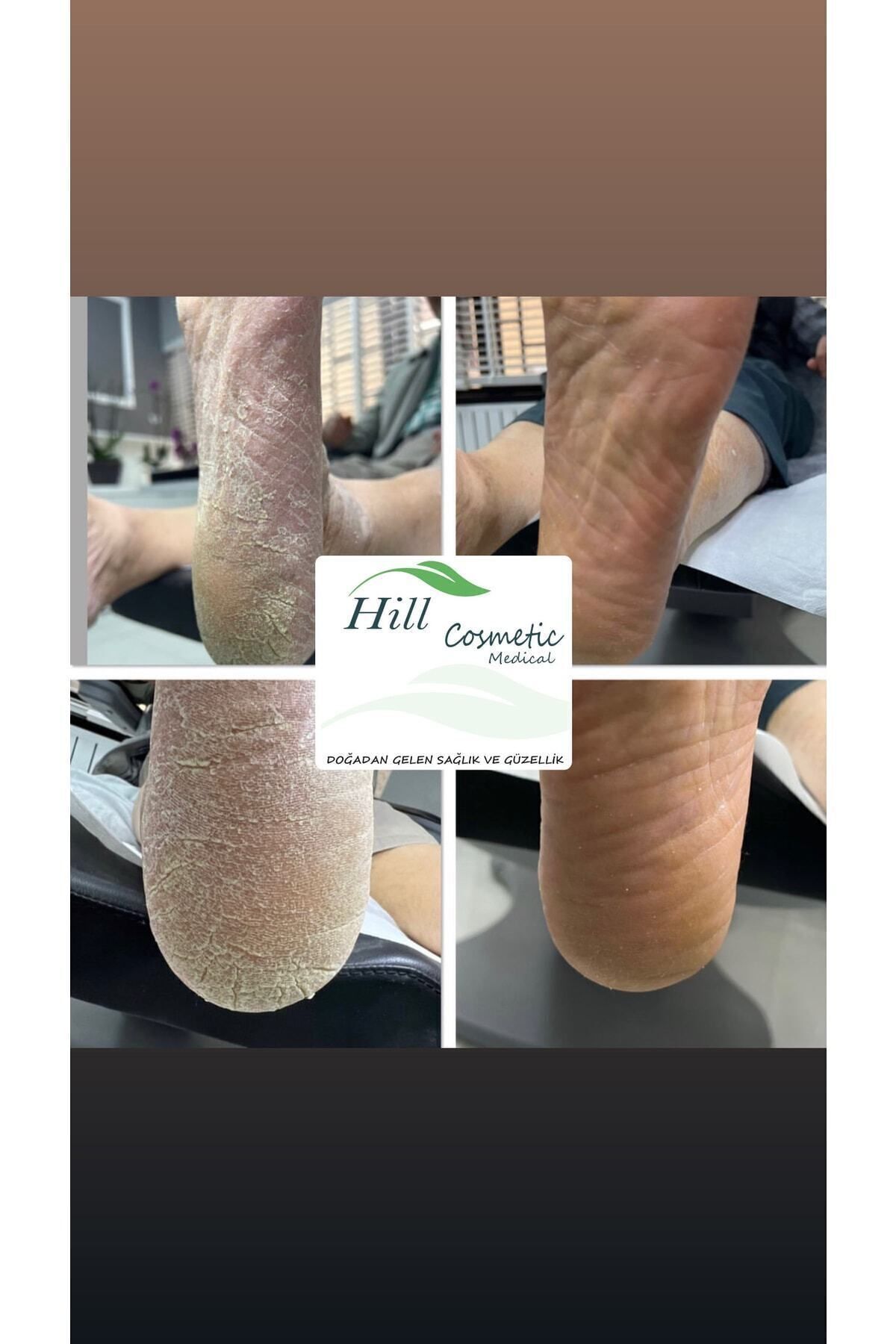 hillfoot-Hill Cosmetic General Foot Care and Heel Cream (Callus and Heel Crack, ) Podology 6