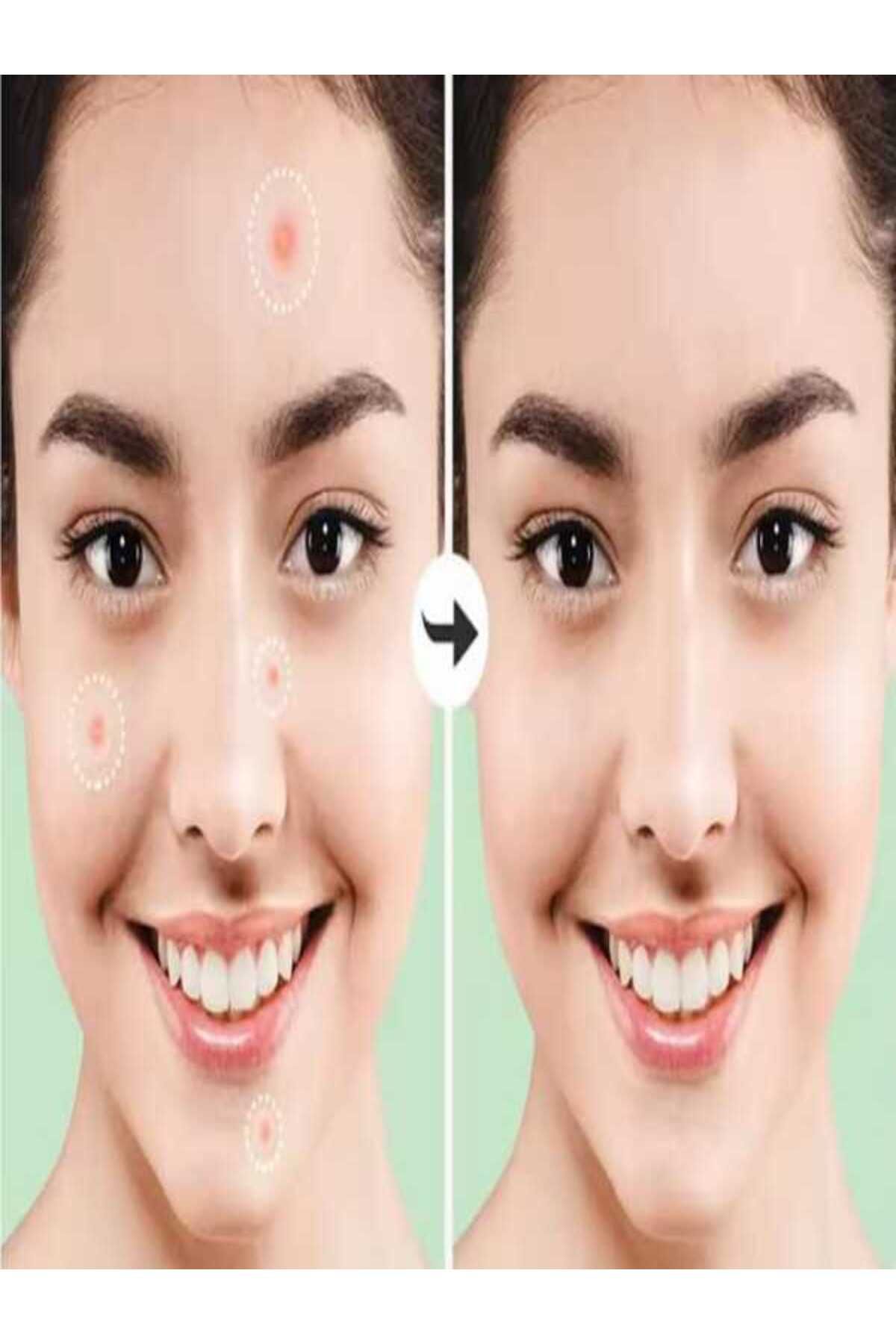 Tıpteknik market Akne Sivilce Bandı 48 Adet Hidrokolloid, Original Pimple Patch Hydrocollaid