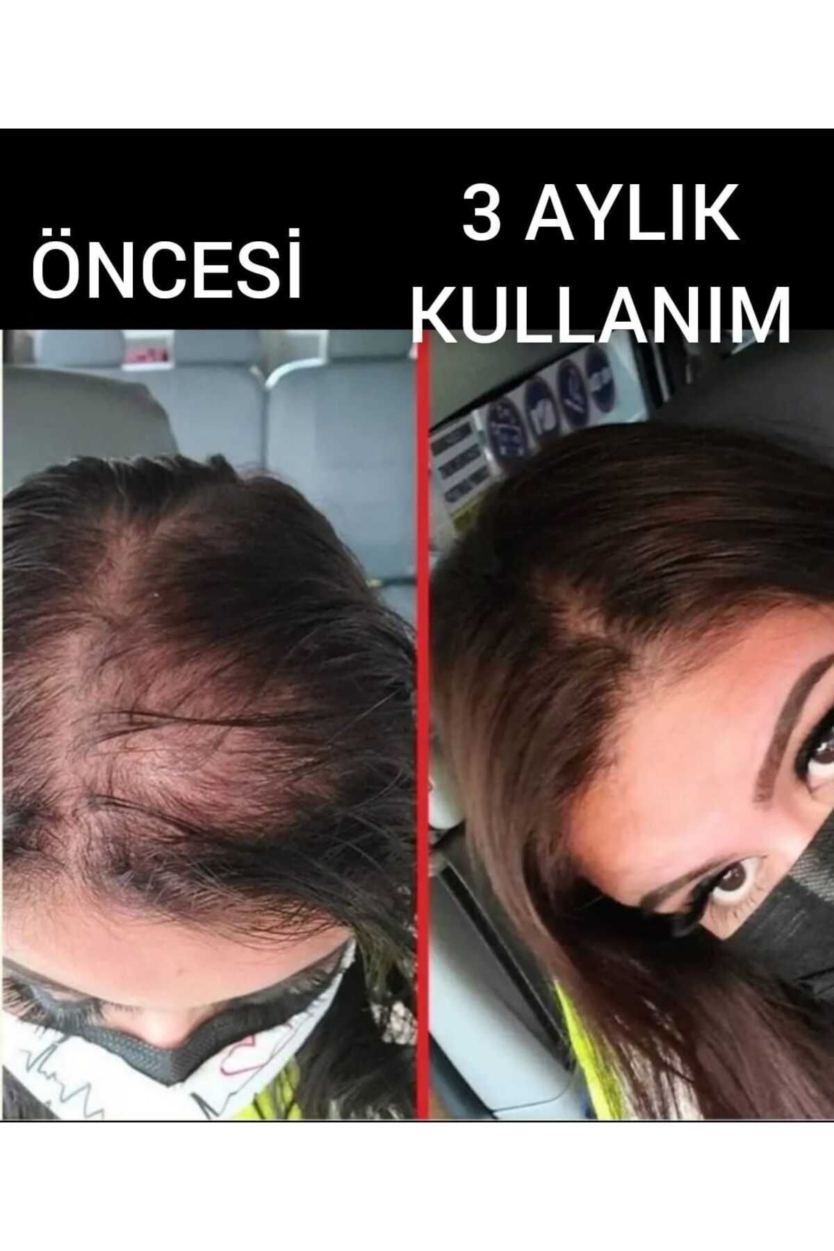 Kadınlara Özel Dermanew Saç Gürleştirici - Saç Losyonu - Saç Çikarıcı Serum / 2 Adet Serum Roller — TYC00195486169 — تصویر 5 از 8