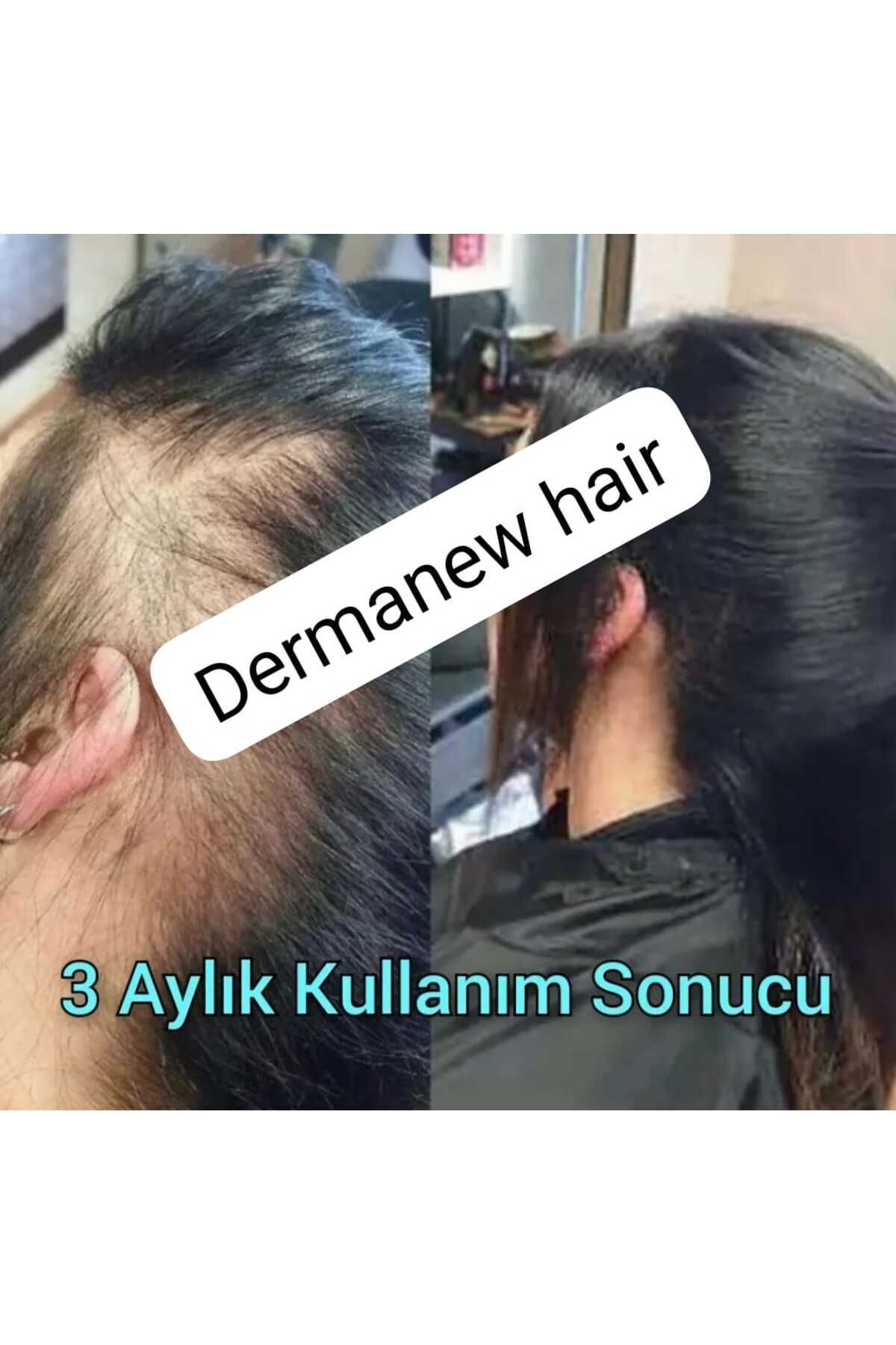 Kadınlara Özel Dermanew Saç Gürleştirici - Saç Losyonu - Saç Çikarıcı Serum / 2 Adet Serum Roller — TYC00195486169 — تصویر 3 از 8