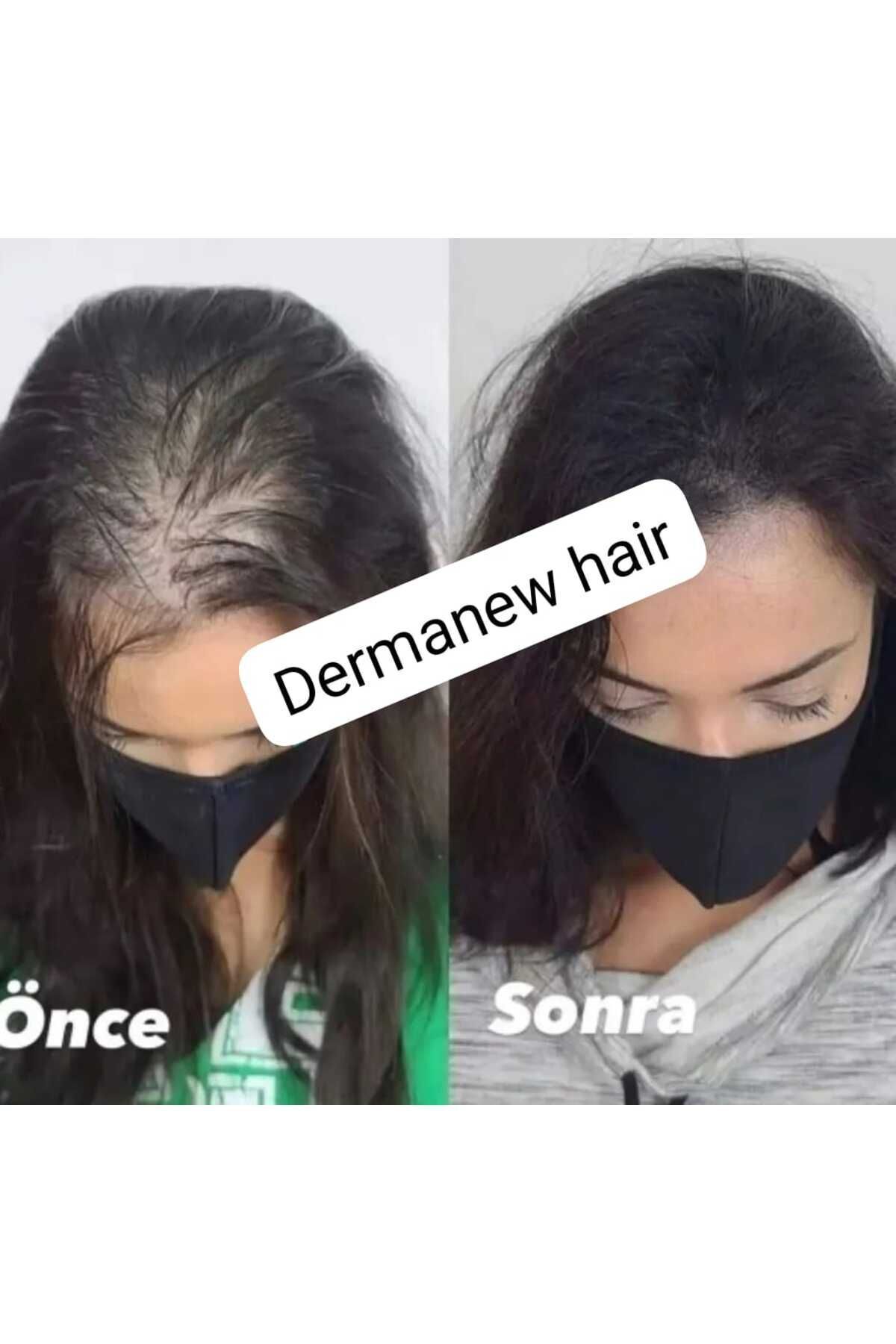 Kadınlara Özel Dermanew Saç Gürleştirici - Saç Losyonu - Saç Çikarıcı Serum / 2 Adet Serum Roller — TYC00195486169 — تصویر 4 از 8